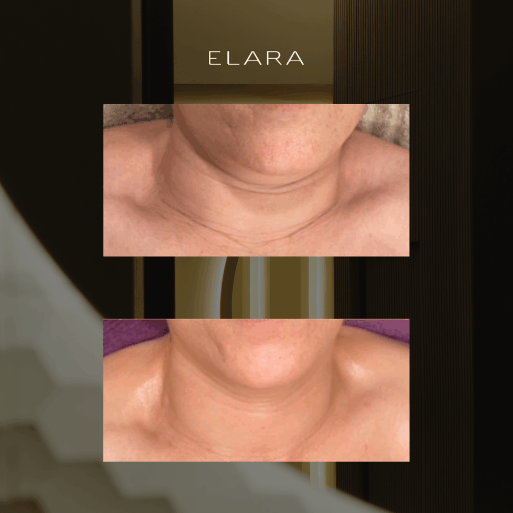 Resultados del Imperium facial en príncipe de Vergara