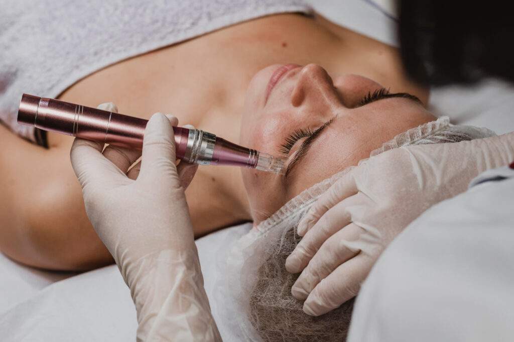 Dermapen facial en Príncipe de Vergara