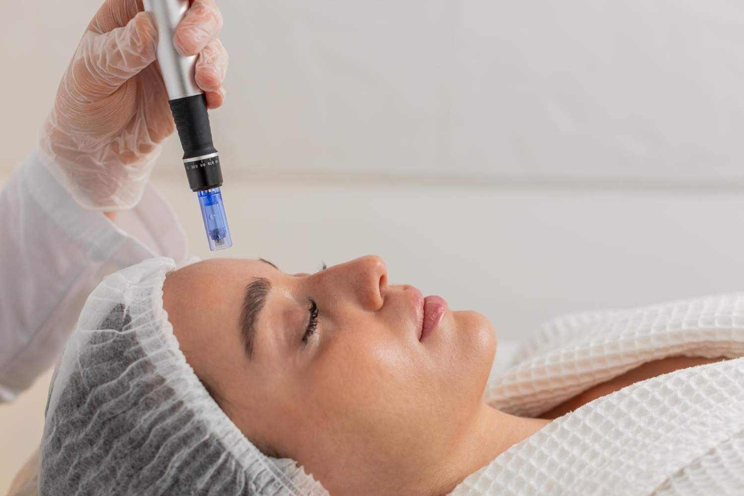 Artículo de Microneedling: cómo mejora la calidad de la piel y por qué Dermapen se ha vuelto tan popular
