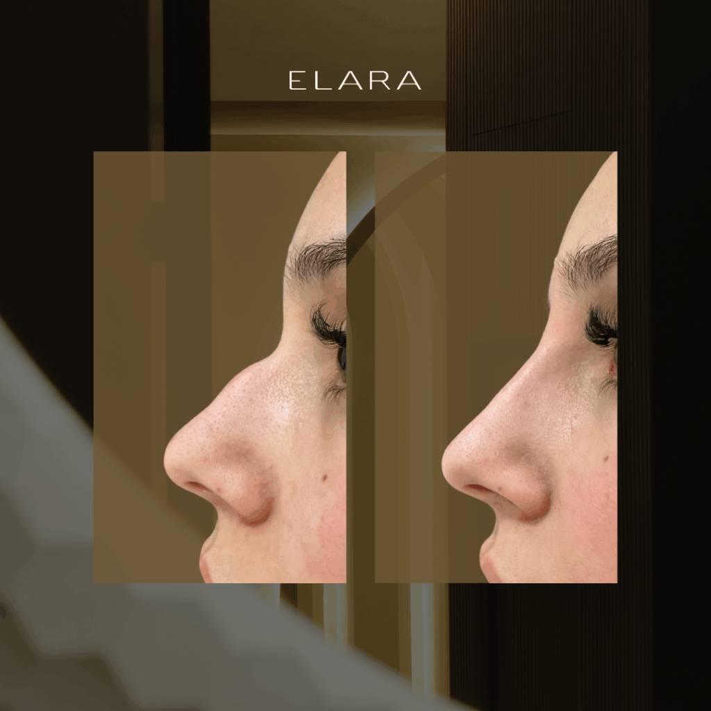 Tratamiento de rinomodelación sin cirugía en príncipe de Vergara