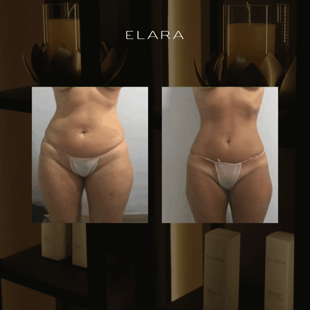 Resultados del Imperium corporal en príncipe de Vergara