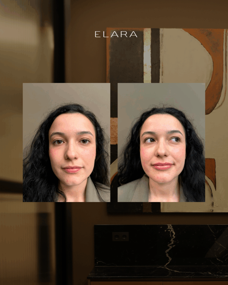 Aumento de labios con ácido hialurónico en Príncipe de Vergara