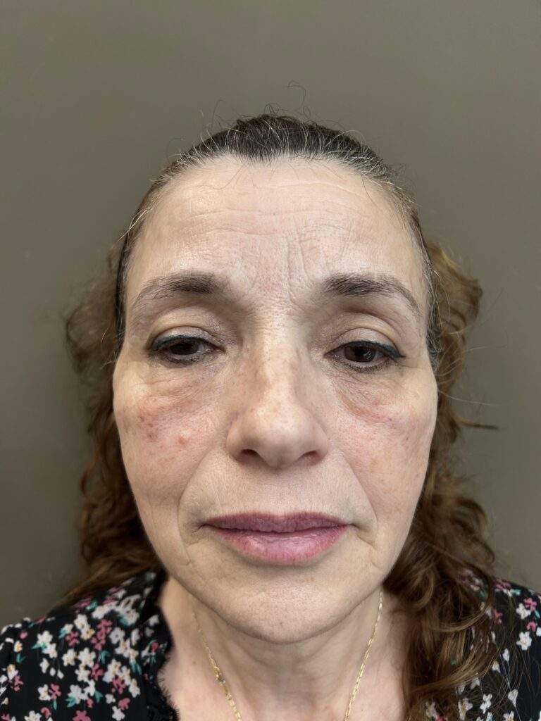 Tercio medio en Príncipe de Vergara