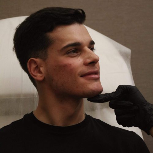 Tratamiento de medicina estética facial de marcación mandibular en príncipe de Vergara