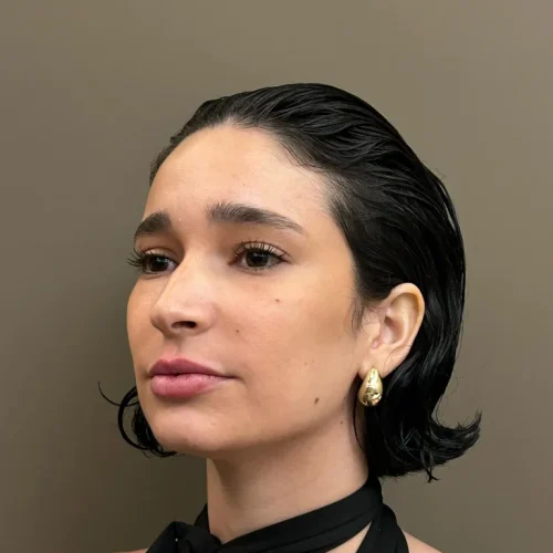 Aumento de labios con ácido hialurónico en Príncipe de Vergara